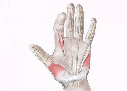 التهاب تاندون ها به عنوان علت درد در مفاصل انگشتان دست