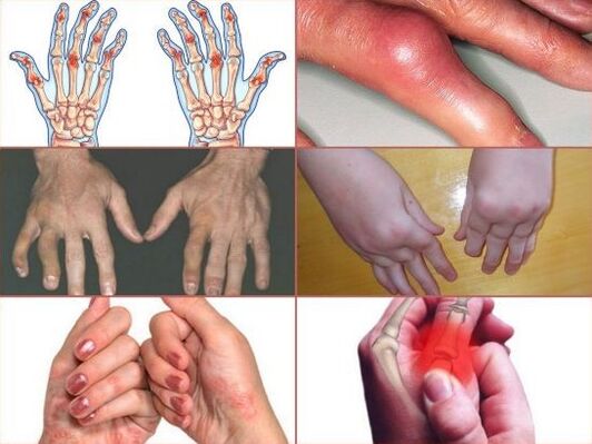 درد در مفاصل انگشتان دست