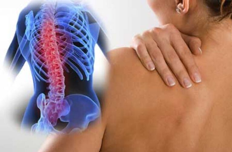 در حین تشدید استئوکندروز ستون فقرات قفسه سینه، درد دورساگو رخ می دهد