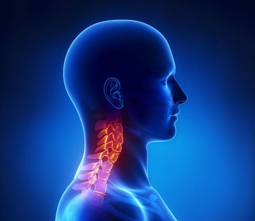 پوکی استخوان گردن یک آسیب شناسی ستون فقرات است که می توانید در خانه از شر آن خلاص شوید