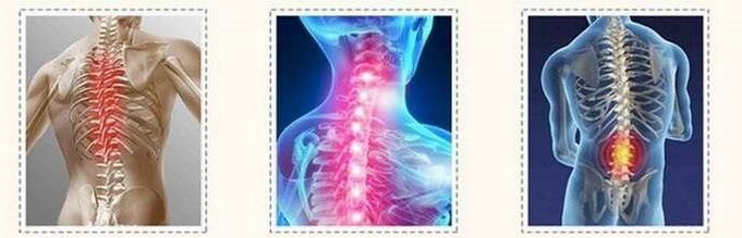 ضایعات ستون فقرات پوکی استخوان